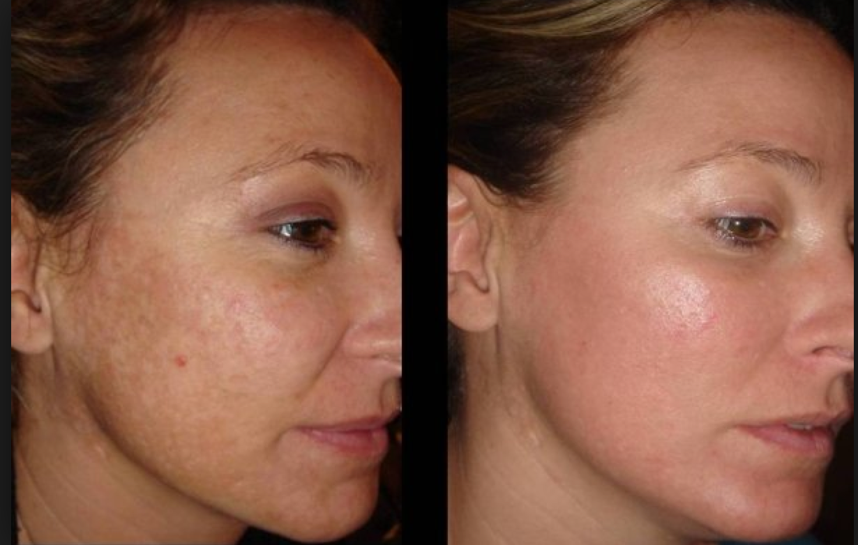 Fraxel treatments for age spots, sun spots (hyperpigmentation)