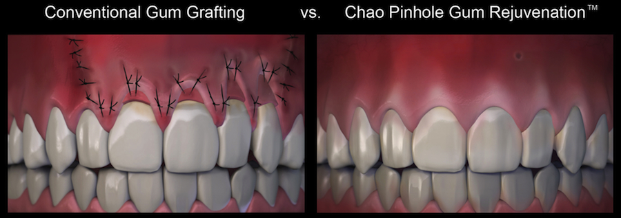 Gum Grafting compared to Chao Pinhole Gum Rejuvenation