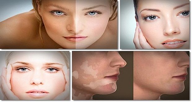 natural vitiligo treatment system review