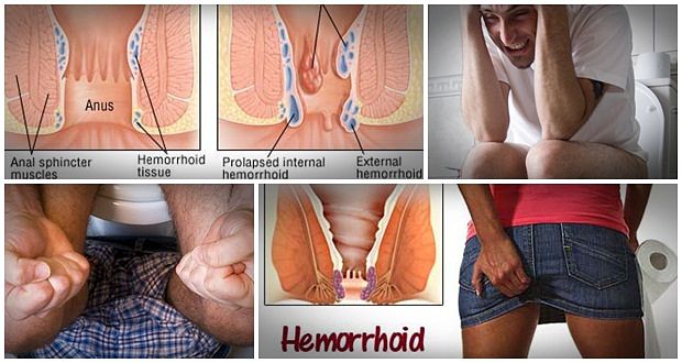 easy hemorrhoids cure review
