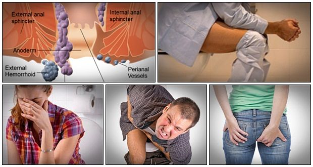 easy hemorrhoids cure review