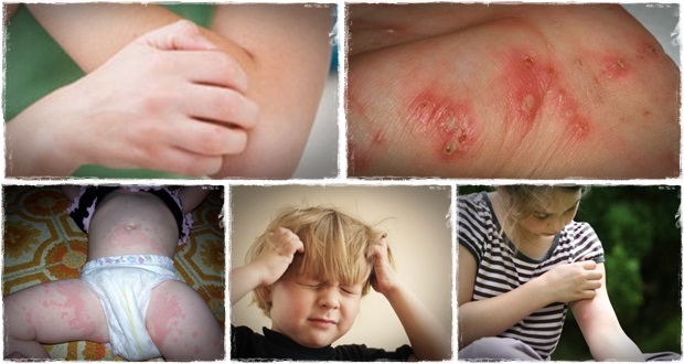 The Scabies 24 Hour Natural Remedy Report Review How To Treat Scabies Fast 9293