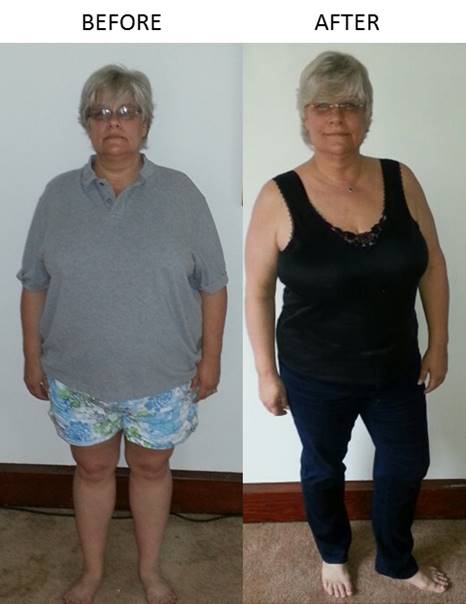 Before After Gastric Sleeve Surgery