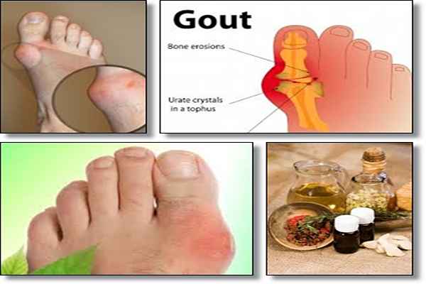 The Gout Remedy Report Review