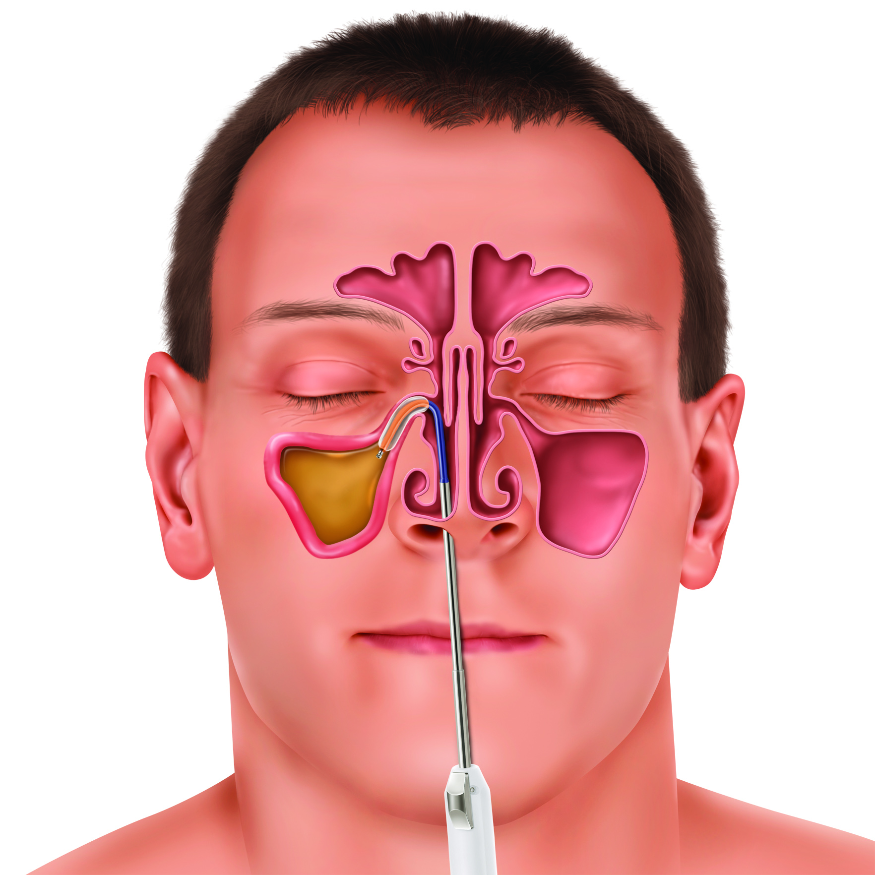 Illustration of Balloon Sinus Dilation Procedure