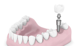Illustration of a Dental Implant, Abutment, and Restoration