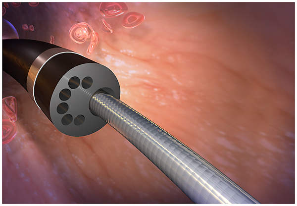 ND Infusion Catheter