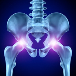 Study Backs Thousands of DePuy Pinnacle Hip Lawsuit Claims of Device ...