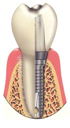 Dental Implants in Fremont