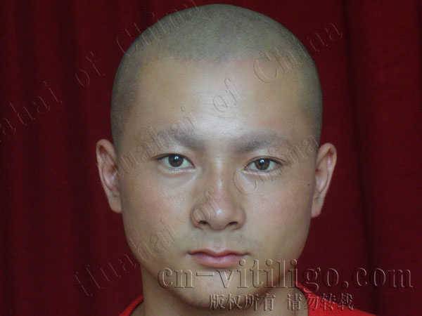 Liguosheng after treatment