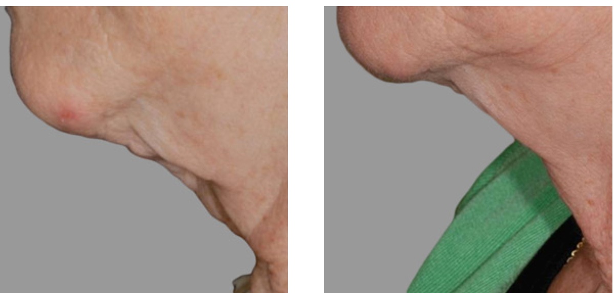 exilis chin and neck before and after