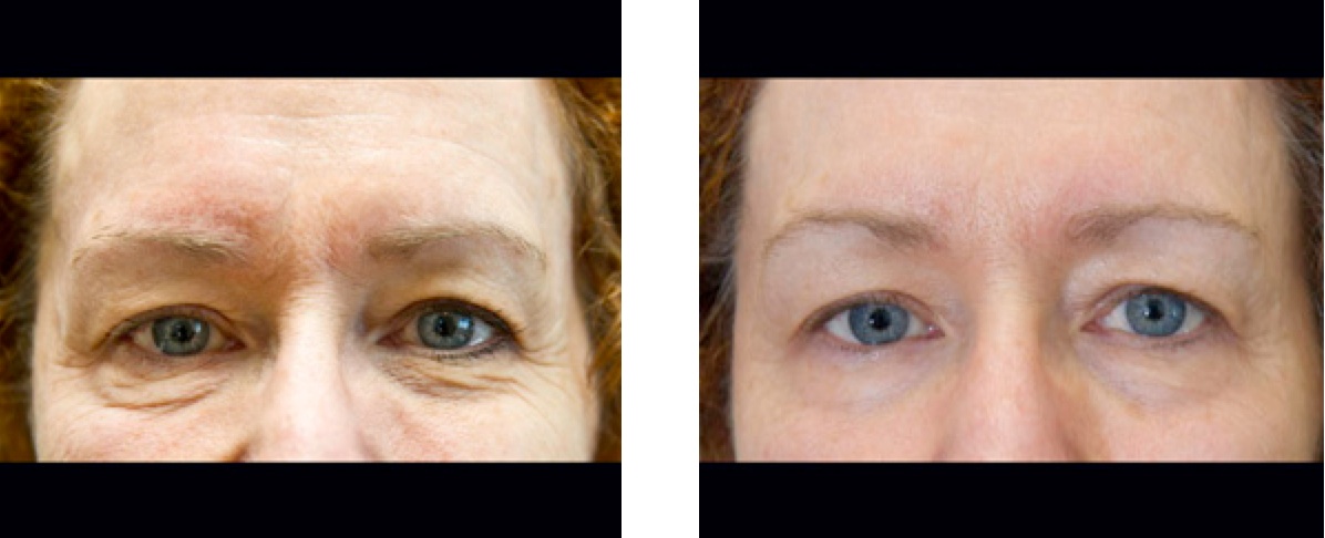 Exilis non surgical eyes before and after