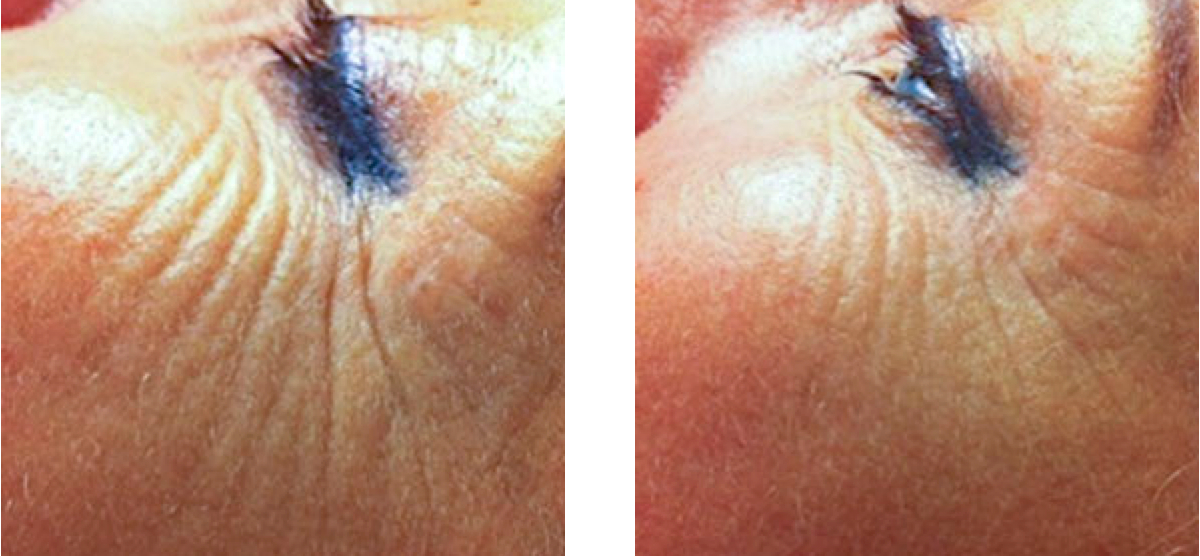 Exilis crows feet