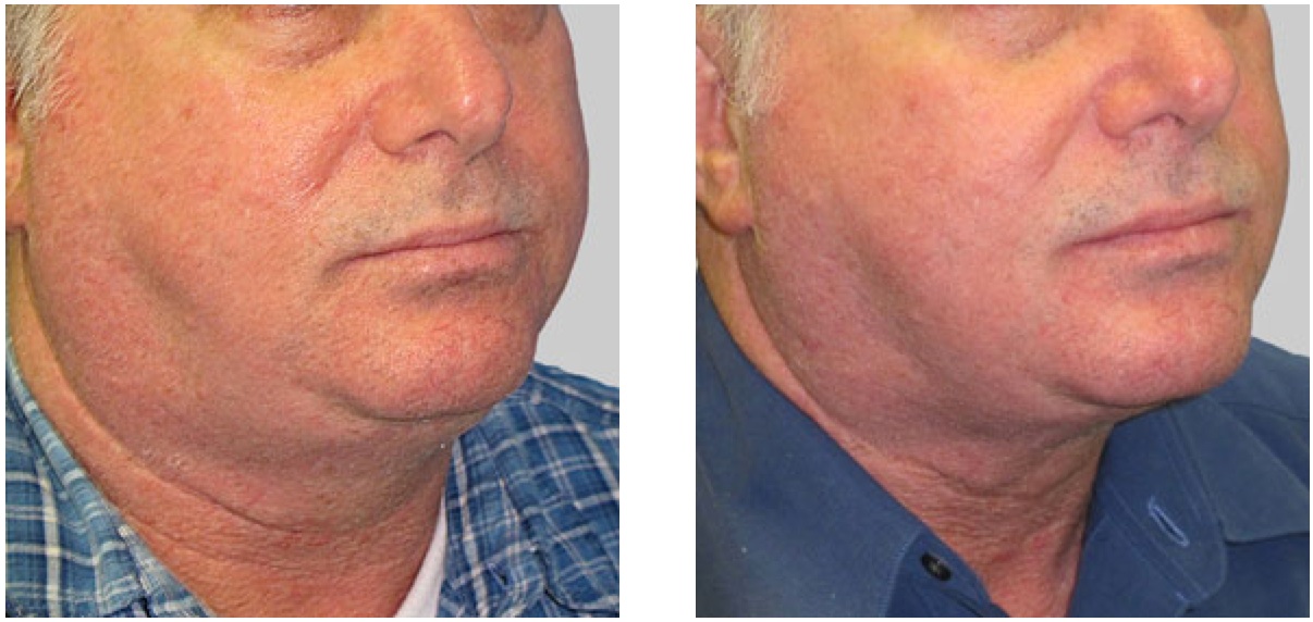 Exilis Image Before and After Male Chin and lower face