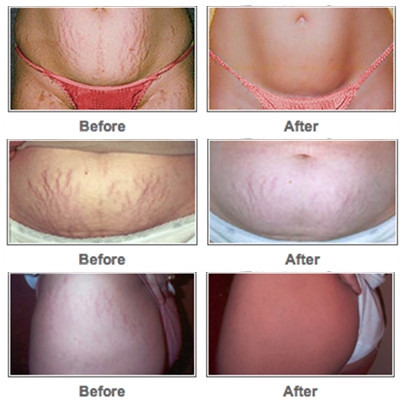 Goodbye Stretch Marks Before and After