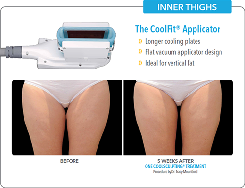 Inner Thigh Fat Reduction