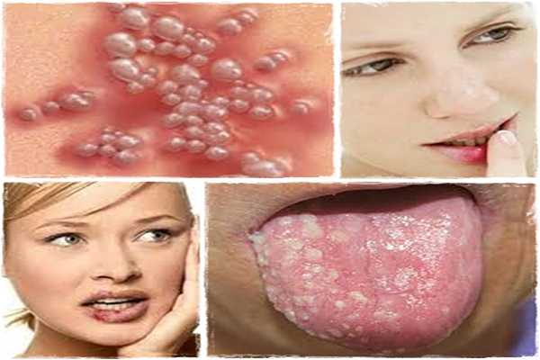 one minute cure for herpes