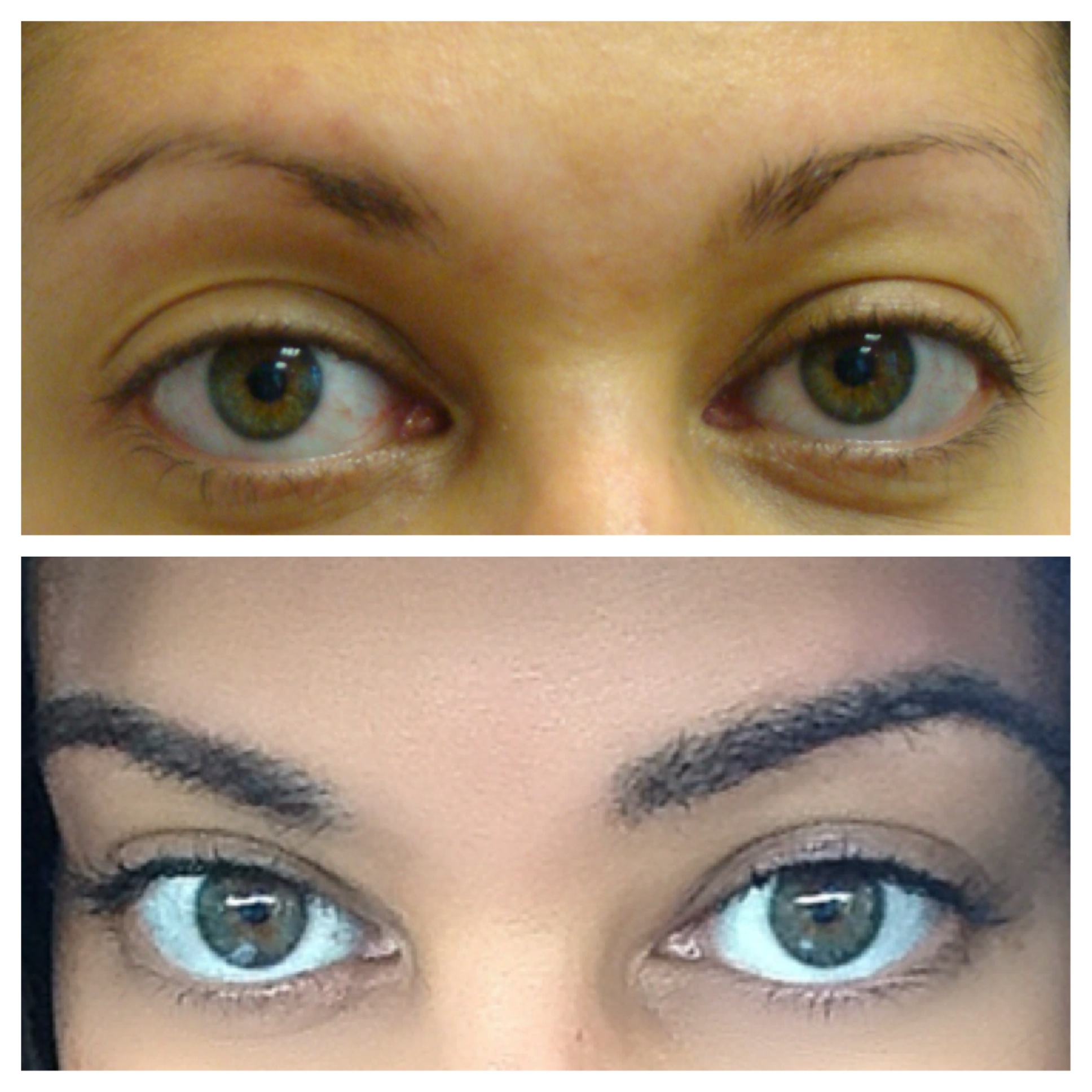 Before and after eyebrow transplant