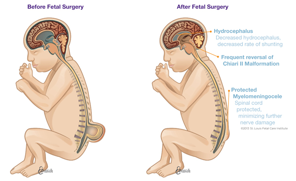 Illustration of Myelomeningocele before and after surgery.