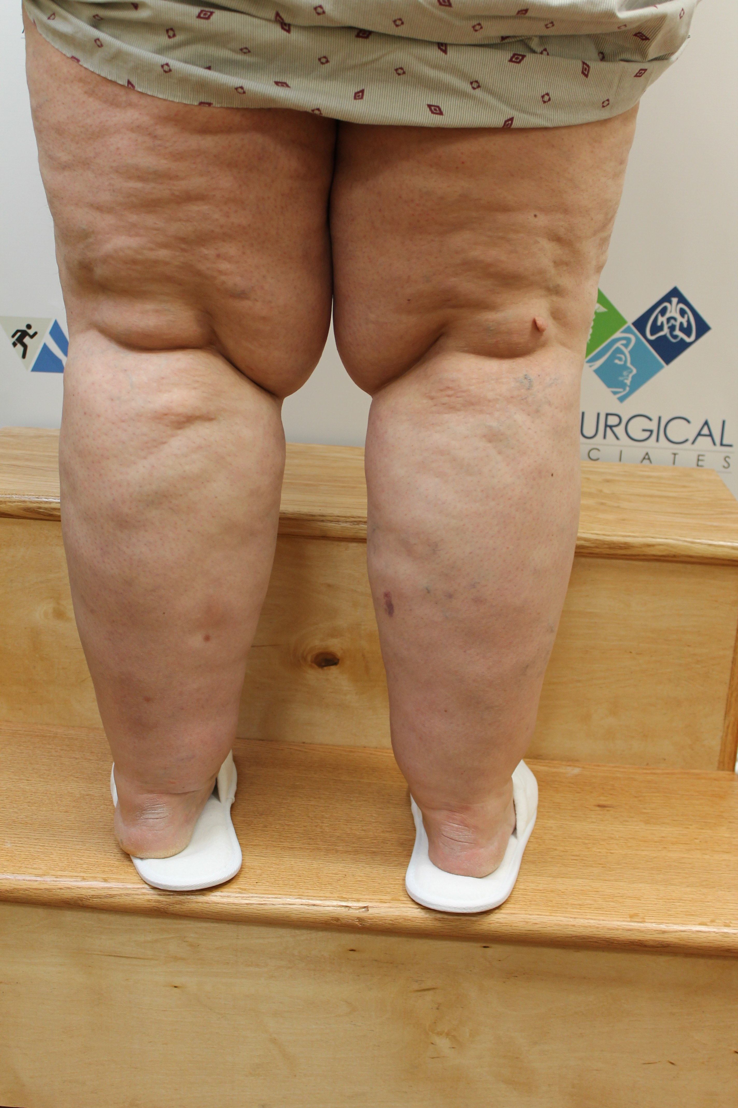 Vicki's legs show the effects of lipedema