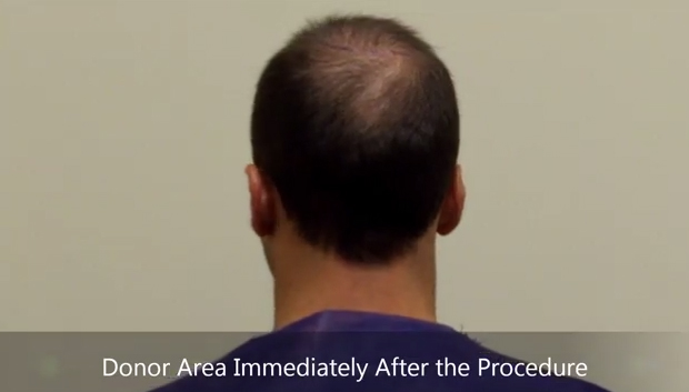 FUE hair transplant patient immediately following procedure with no-shave technique
