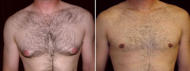 Gynecomastia Before and After