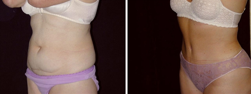 Tummy Tuck Before and After