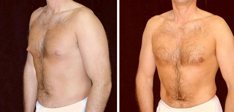 Gynecomastia Before and After