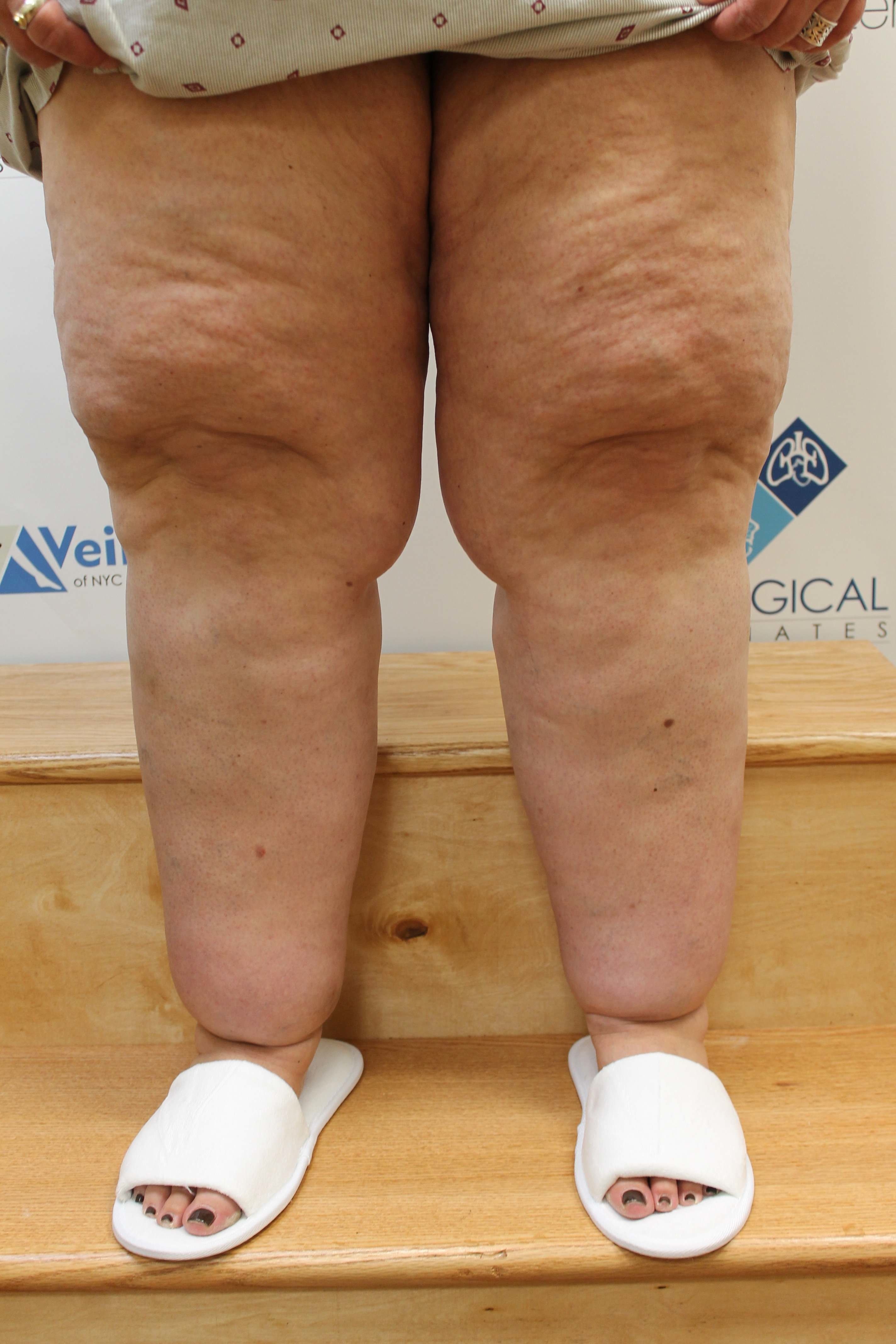 Legs of a woman with advanced lipedema