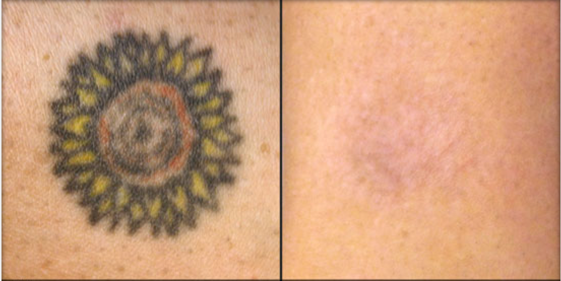 PicoSure Tattoo Removal Before and After
