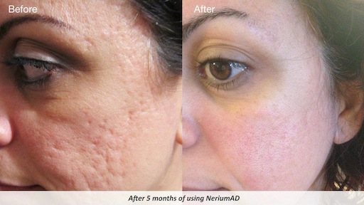 NeriumAD Results