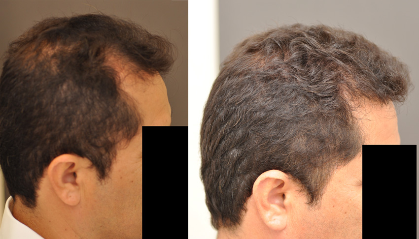 Before and after NeoGraft FUE hair transplant - side profile