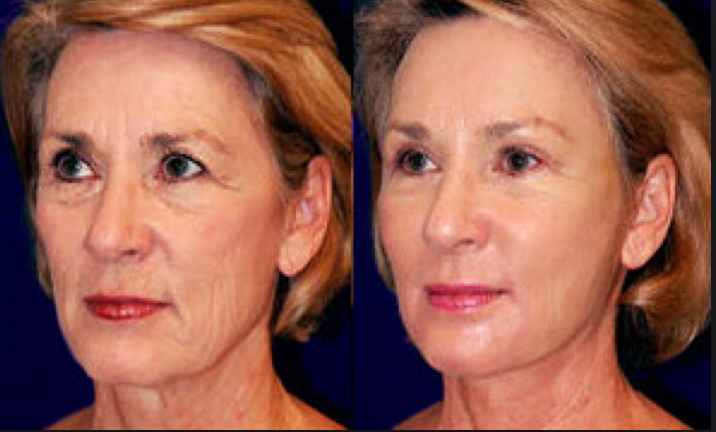 Before and after filler procedure using cannula technique
