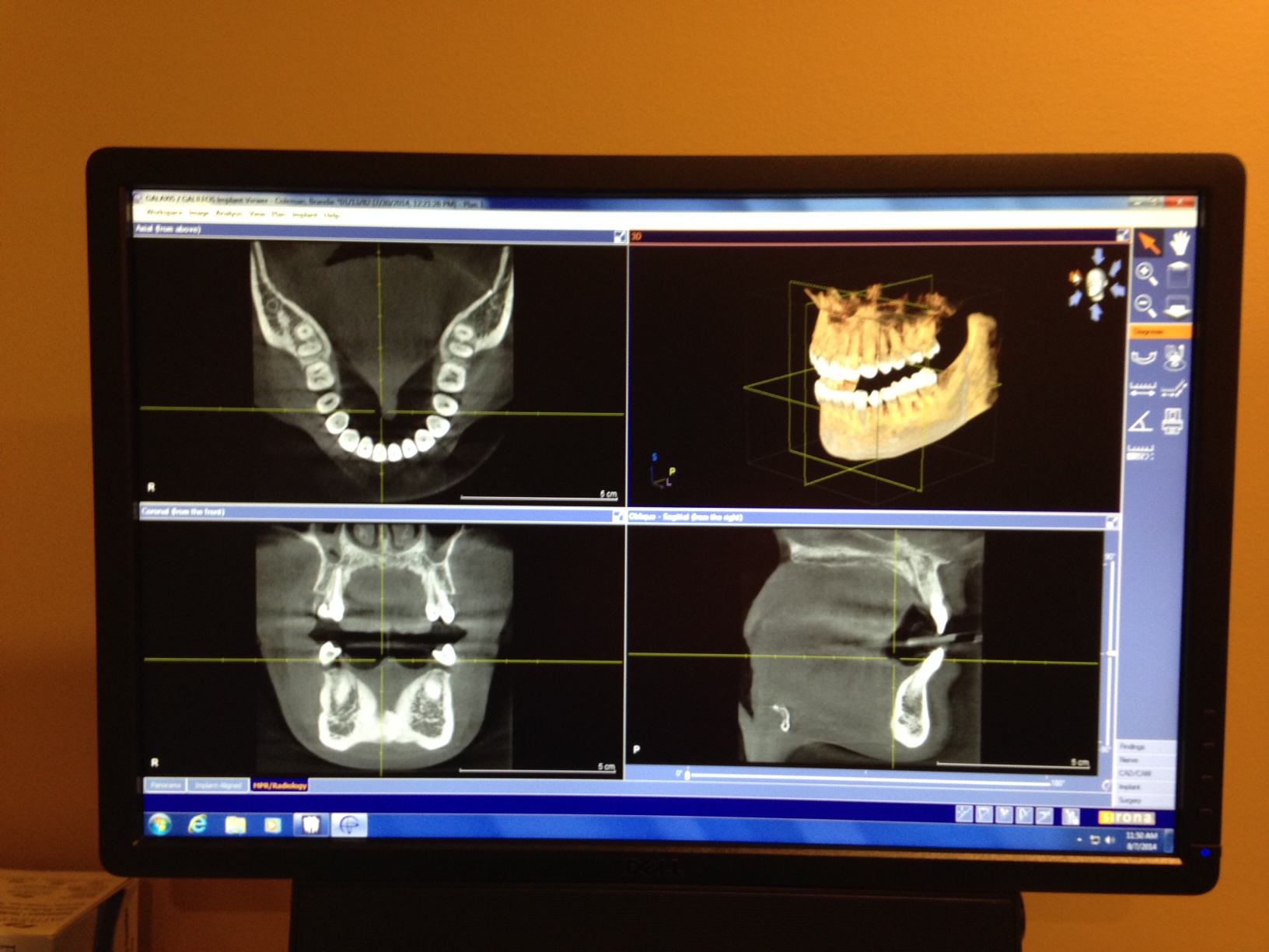 Closeup of Cone Beam CT Scan at Grandview Dental Care
