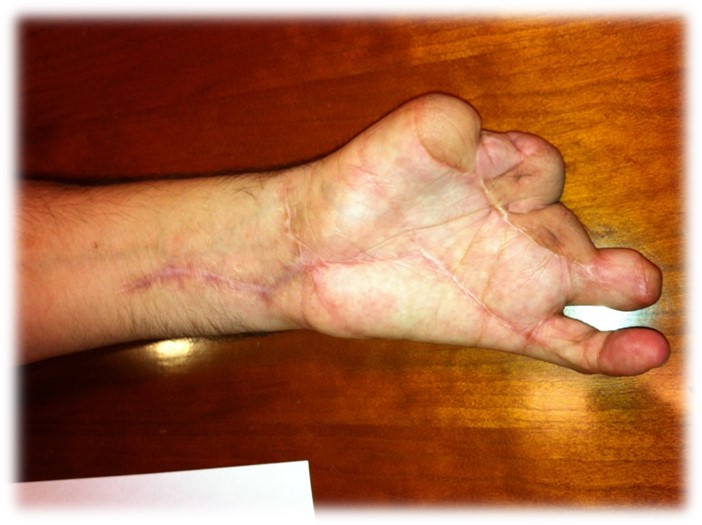 Claimant's Injured Hand (2)
