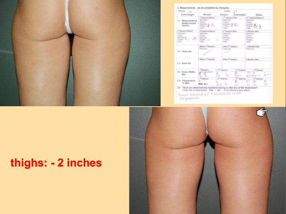 Exilis non surgical fat loss thighs
