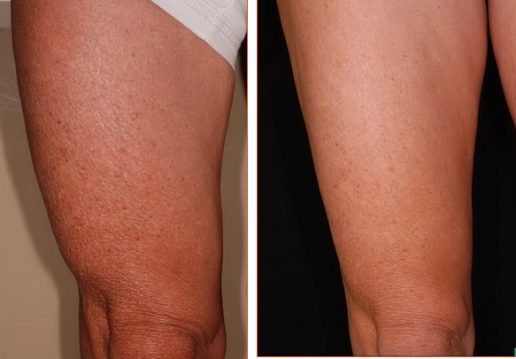 Exilis non surgical fat reduction thigh