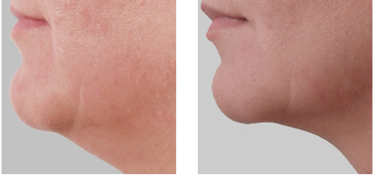 Exilis non-surgical fat reduction chin