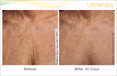 Ultherapy Before and After Photos