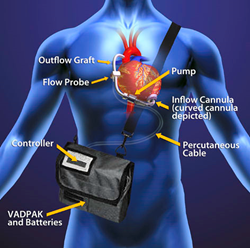 ReliantHeart Commences FDA Trial on HeartAssist5® VAD