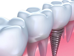 Chula Vista Dentist Offering $1,699 Dental Implant Special ...