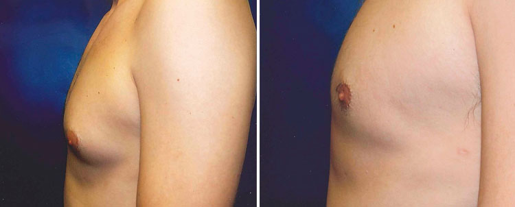 Male breast reduction before-and-after photo