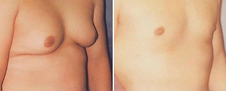 Gynecomastia before-and-after photo.