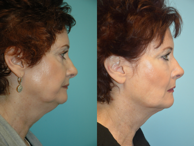 Actual Patient Before and After at The Maloney Center for Facial Plastic Surgery