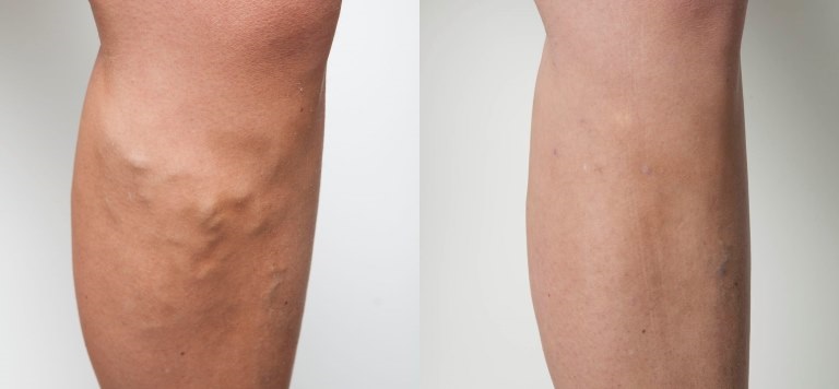 EVLA varicose vein treatment results