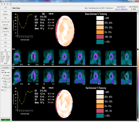 Syntermed's Emory Toolbox is one of the most widely applied methods of cardiac imaging used in nuclear cardiology labs worldwide. ECTb V4 supports ASNC ImageGuide Data Registry.