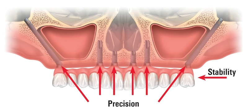 Model of How Zgomatic Dental Implants are placed to support fixed teeth