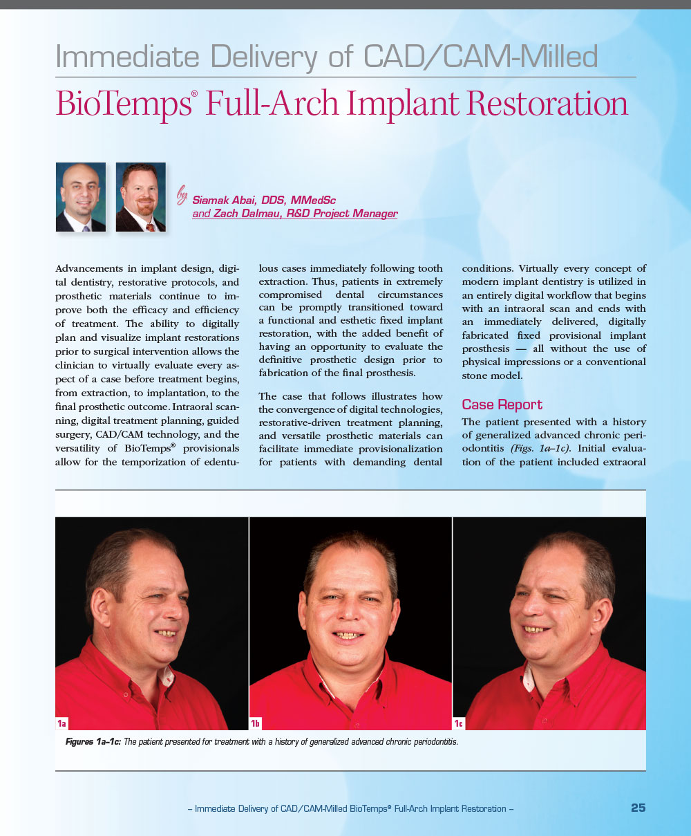 Immediate Delivery of CAD/CAM-Milled BioTemps® Full-Arch Implant Restoration
