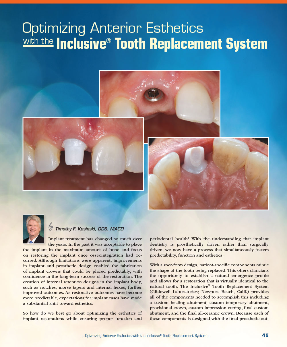 Optimizing Anterior Esthetics with the Inclusive® Tooth Replacement System