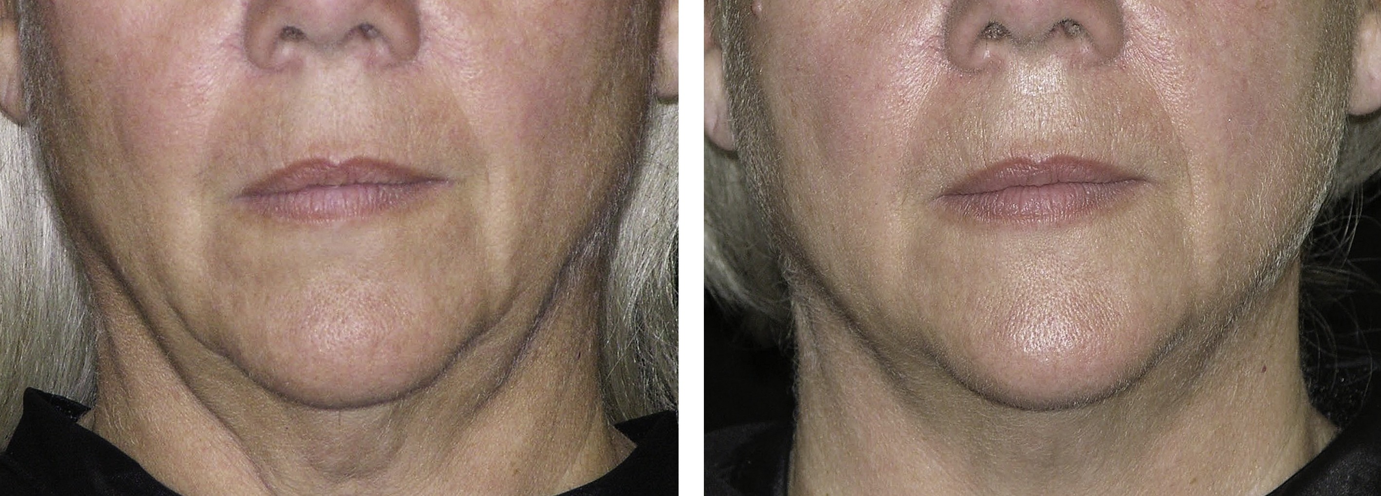 Thermage Neck Skin Tightening